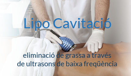 lipo cavitacio barcelona