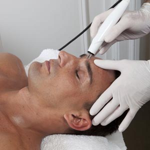 radio frequencia facial lifting barcelona